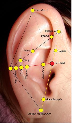 145. Bartholonitis, rechts
